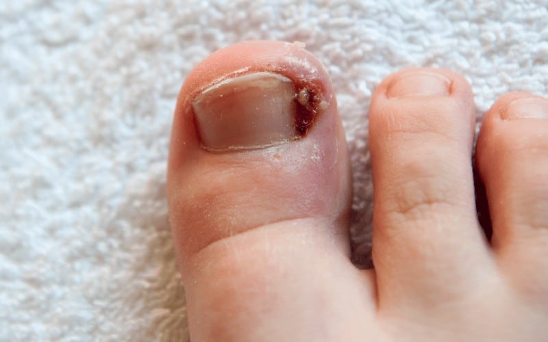 Understanding The Pros And Cons Of Laser Treatment For Toenail Fungus