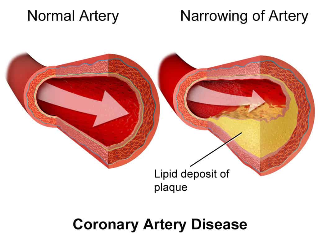 Preventing Coronary Artery Disease