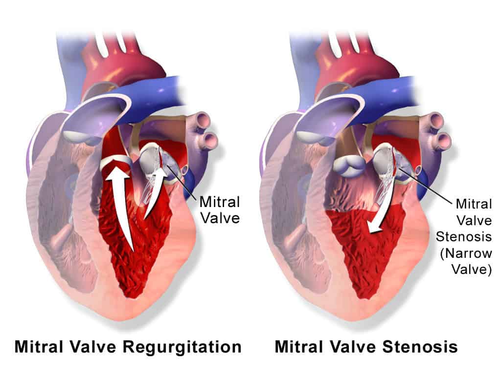 Heart Valve Disease Prevention