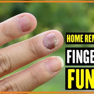 5 Home Remedies For Fingernail Fungus - Body Cure