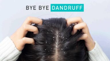 Home remedies to get rid of DANDRUFF permanently! 10 NATURAL dandruff remedies that work!