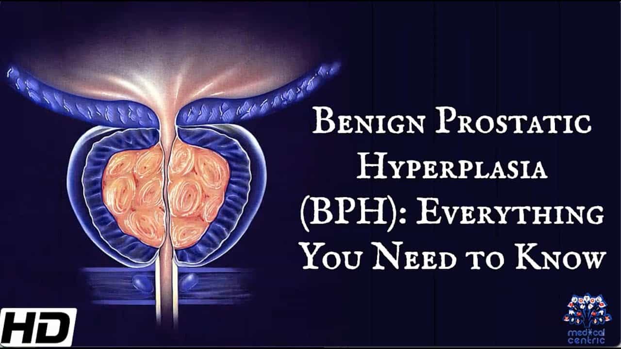 What Is Benign Prostate Hyperplasia