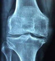 knee joint pain arthritus