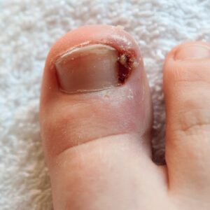 the Pros and Cons of Laser Treatment for Toenail Fungus